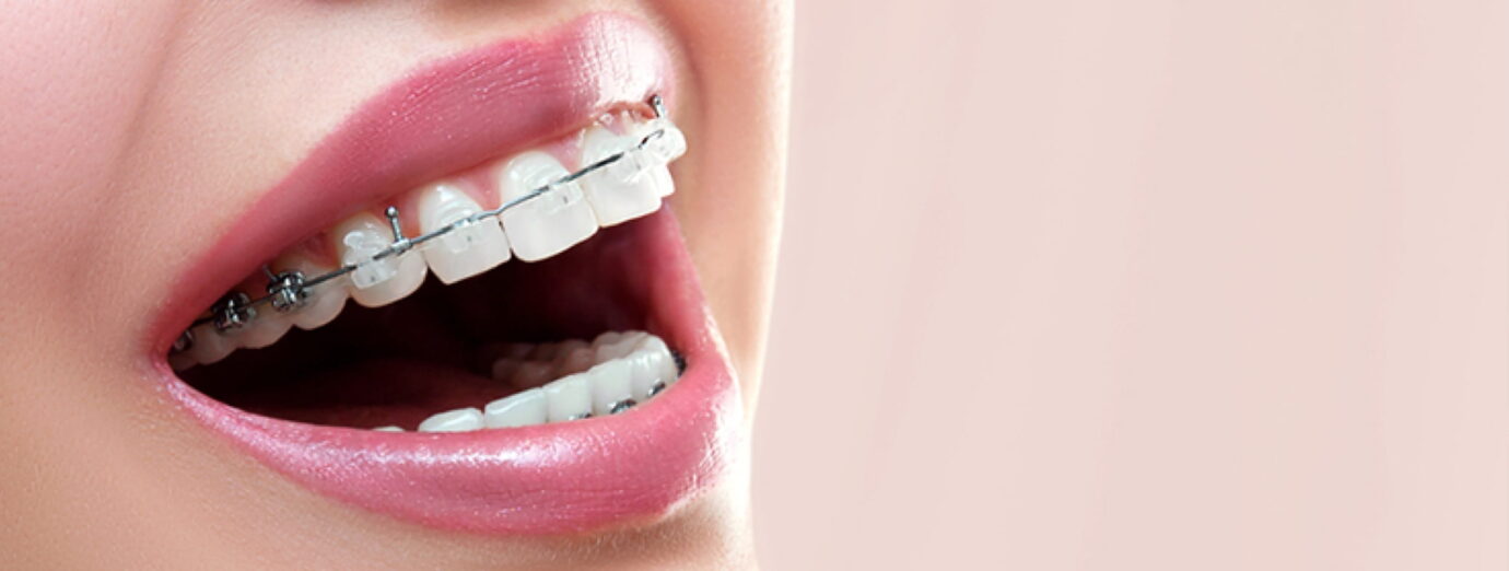 Traditional Braces