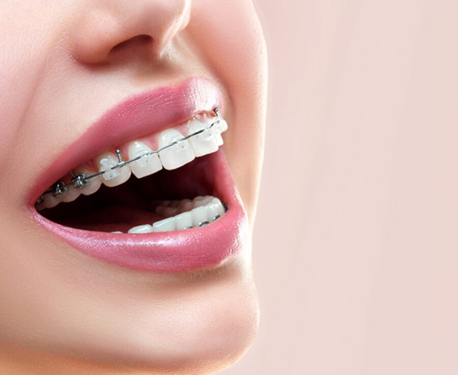 Traditional Wired Braces