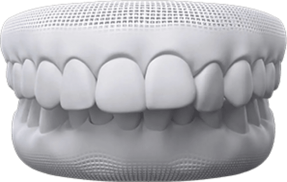 Overbite treatment