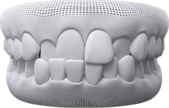 Crossbite treatment